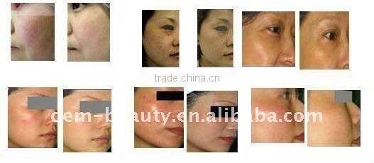 2011 Hotsale Portable Equipment IPL RF E-light Eliminate Spider vein C001