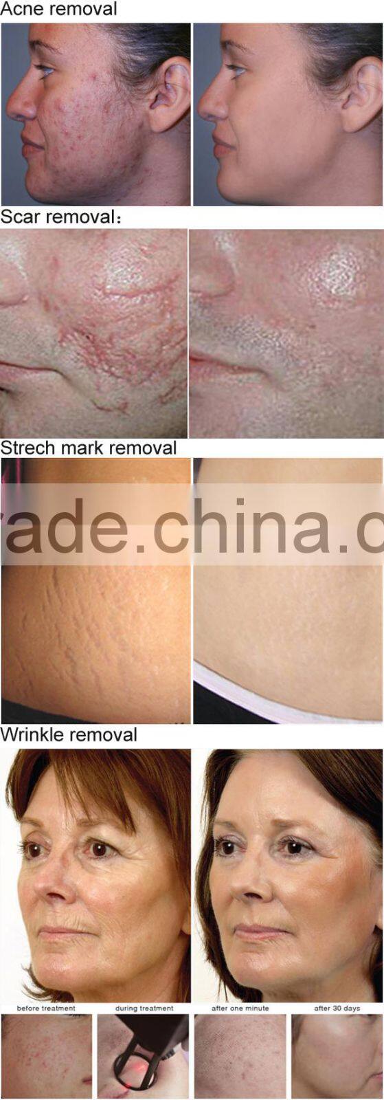 2014 new professional Glass&RF tube 10600nm 40w vertical co2 fractional laser machine