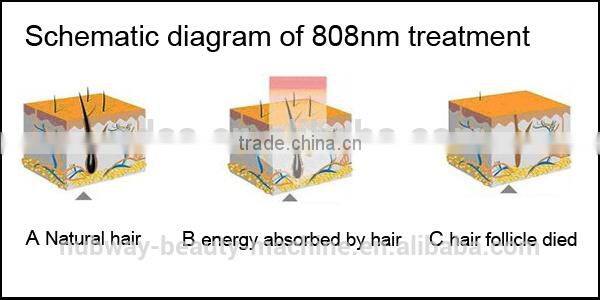 Alibaba Express From China To Portugal Laser Diodo 808nm Portable