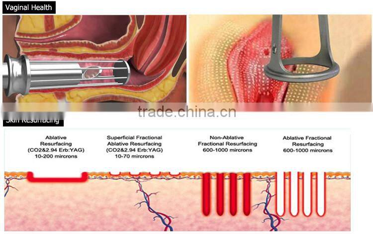High energy rf tube vaginal rejuvenation rf co2 fractional laser machine