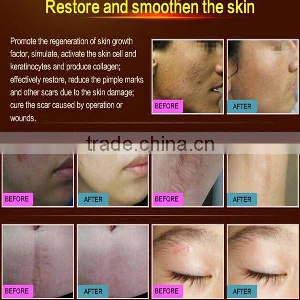 NEWEST! Face Whitening Acne scar Treatment and Pimple Removal Cream