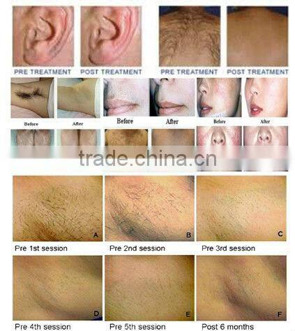 Top quality low price salon machine professional high performance diode laser hair removal fda approved