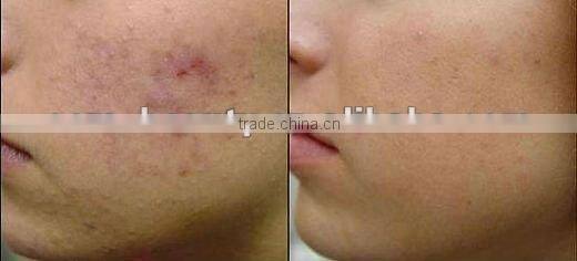 540 needles derma oller anti aging anti hair removal with ce approval L005