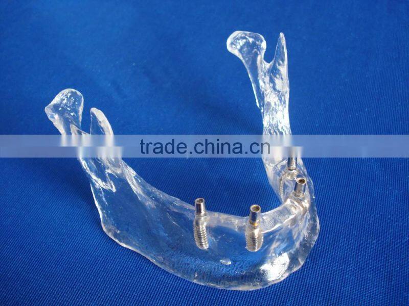 Hot Sale Transparant Mandibule Implant Model