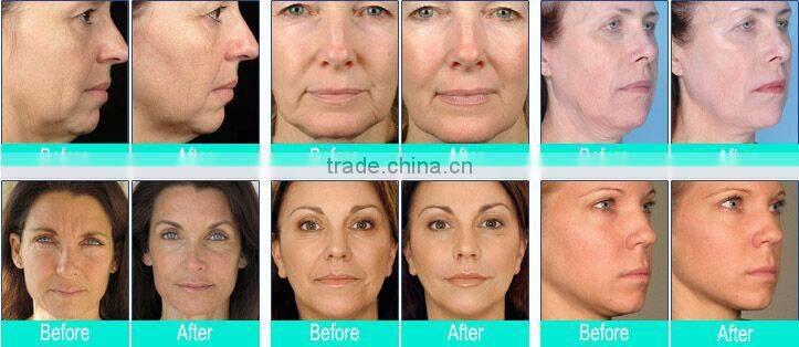 Portable hifu 40000 shots face lift ultrasound machine and wrinkle removal device