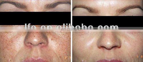 LEFIS All skin types painless q switched nd yag laser&black doll TIP with hair removal