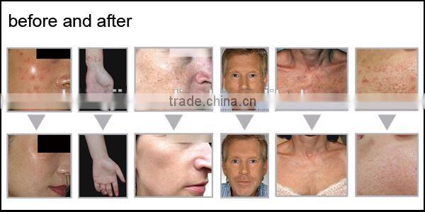 Medical ce approval fractional co2 laser portable medical /fractional co2 laser mini