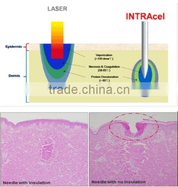 skin renewal micro needle fractional rf laser acne removal machine