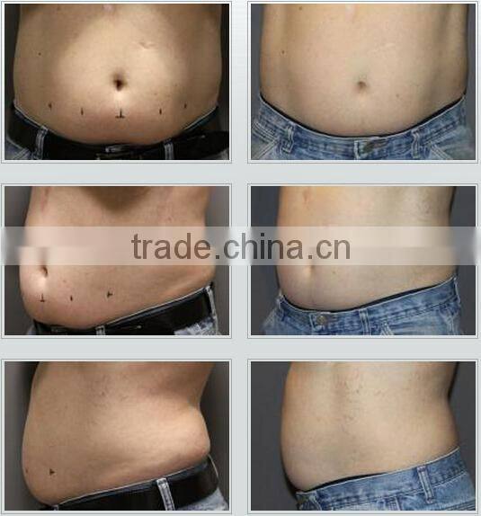 Portable Fat Freezing Slimming Machine Home Device