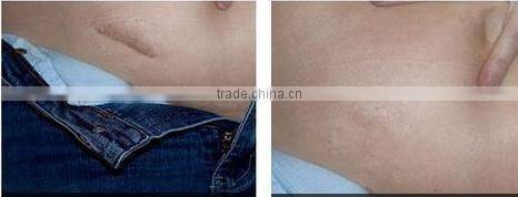 beauty studio acne scars treatment body dermaroller 1080 needles -L008