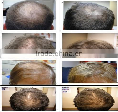 Hair Growth Diode Laser / hair growth laser/ Diode Laser Hair Growth / Hair Loss Treatment