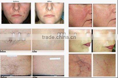 Mini home use IPL (hair removal,CE approved)