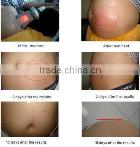 2 handles cryolipolysis machine criolipolisis fat freezing antifreeze membrane