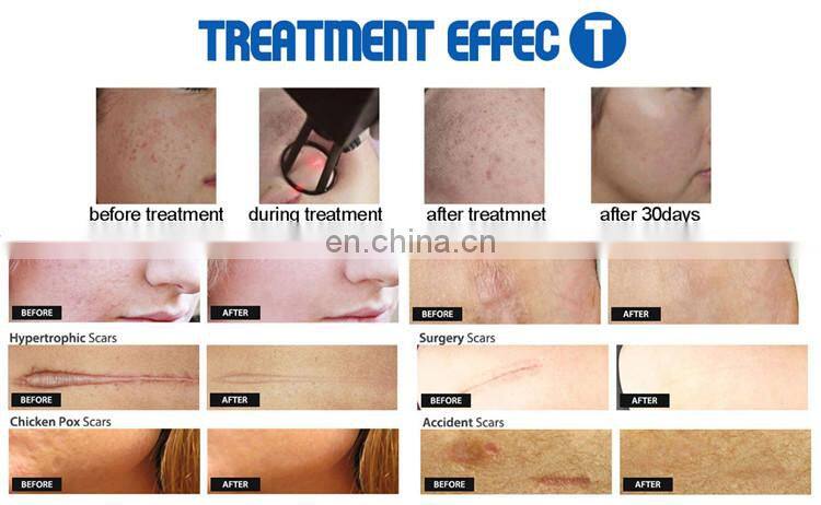 Technology advanced co2 fractional laser skin resurfacing fractional co2 laser machine