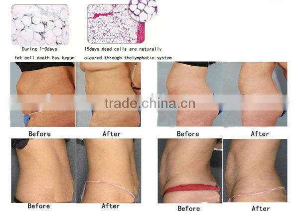 Lipo Cryo Max Machine With RF And Ultrasound