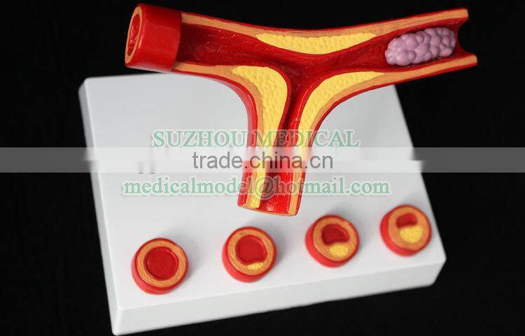 Atherosclearosis and thrombosis model