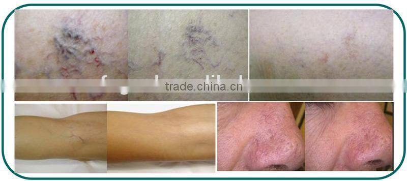 2015 New Product 30W Diode Laser 980nm Vascular Vein Stopper