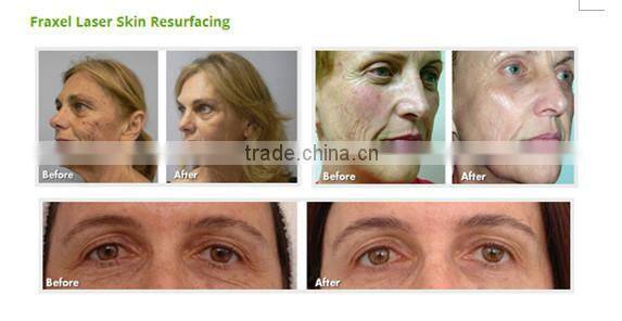 600 micro needle face and body 360 rotating derma roller 0.25mm