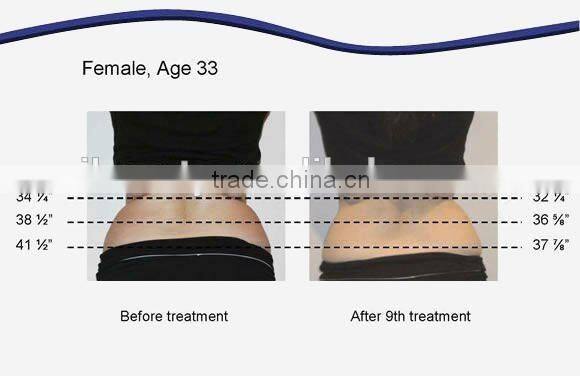 vacuum/ cavitation / RF / Laser fat system / slimming equipment LS650