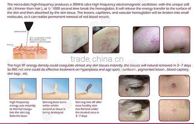 Immediately Result 980nm diode laser spider veins facial redness removal RBS03