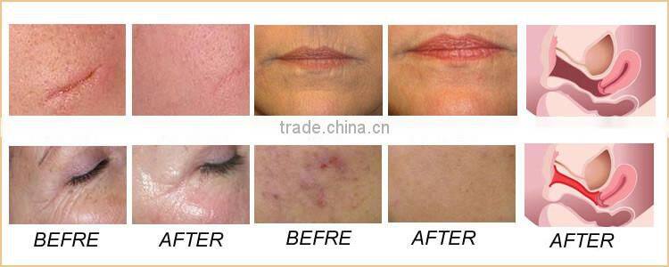 High energy rf tube vaginal rejuvenation rf co2 fractional laser machine