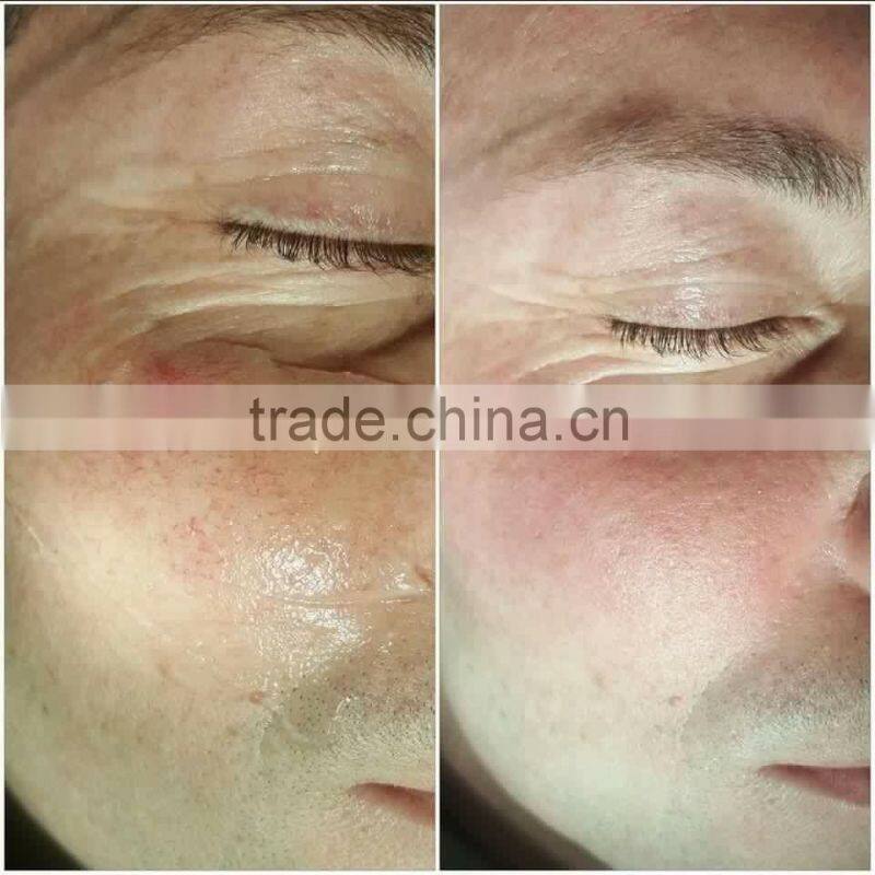 Promotion Effective Vascular Removal Machine Diode Laser 980