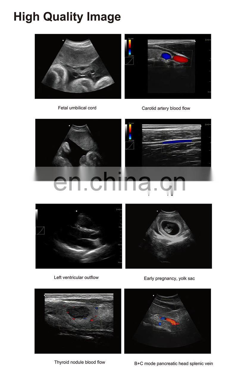 HC-A013A Cheap price  medical Laptop Color Doppler Ultrasonic Diagnostic System portable color doppler ultrasound
