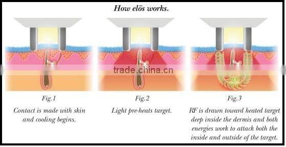 SUSLASER Elight laser hair removal machine