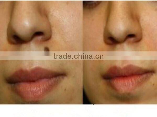 Professional tattoo anesthetic tattoo machines Q-Switch ND Yag Laser Machine For Laser Tattoo Removal or Birthmark Removal