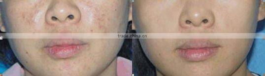 E Light Ipl & Rf Hair Removal Skin Rejuvenation on sale