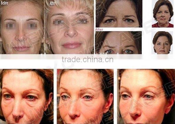 2016 hifu cartridge/hifu machine for wrinkle removal