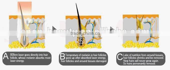 808mm diode laser hair removal /permanent hair removal machine