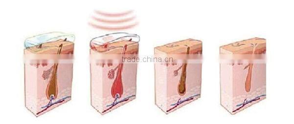 IPL rf laser hair removal equipment, Global hot sale elight ipl rf laser