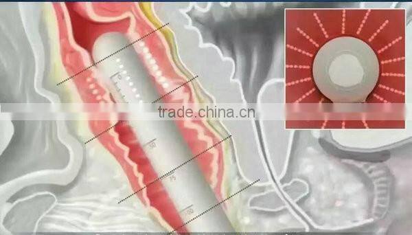 Popular HIFU vaginal tighten machine