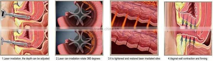 Professional ODM /OEM service 10600nm skin resurfacing & vaginal tightening medical fractional co2 equipment