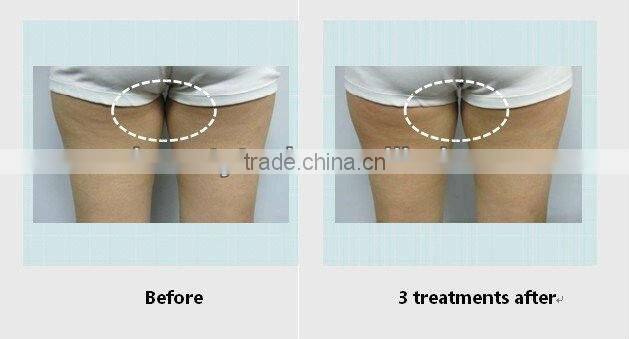 2015 portable&home use cavitation slimming system