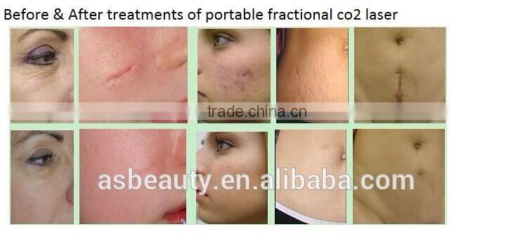 Portable 10600nm CO2 fractional laser equipment for scar removal/co2 laser 1kw
