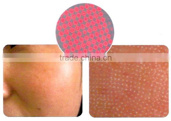 er yag laser Skin Rejuvenation scar removal machine Erbium laser remove chloasma CO2 laser