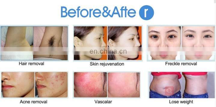 Good quality portable lumenis ipl adena ipl machine with big power