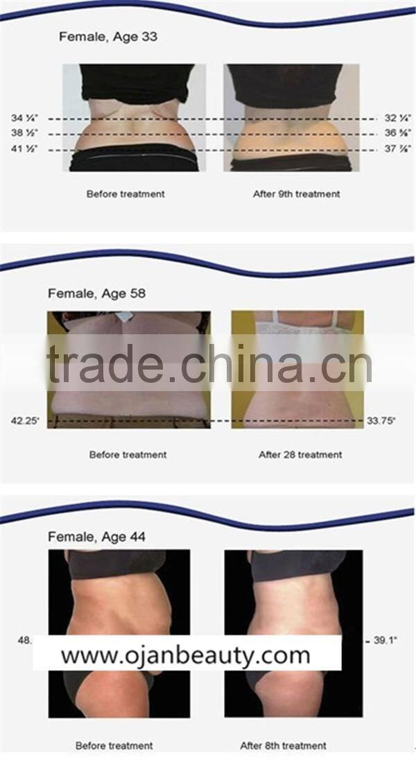 650nm lipo laser weight loss / weight loss laser machine / lipo laser fat reduction