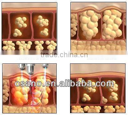 osano portable rf slimming machine - rf radio frequency ultrasound cavitation machine for sale lower price !