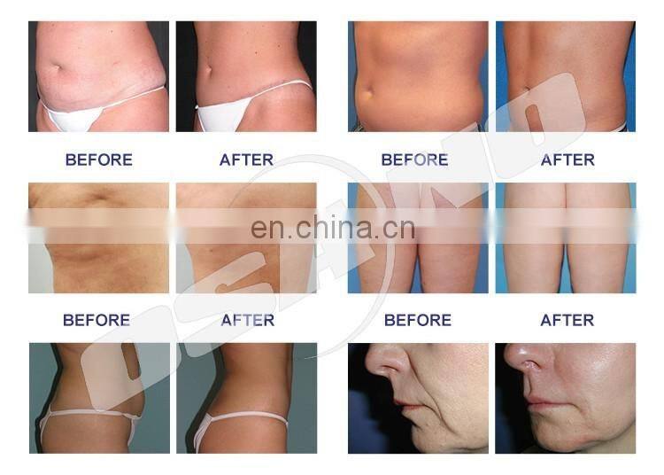 VELASHOCK combines RF velashape with shock wave therapy Vacuum Roller beauty equipment