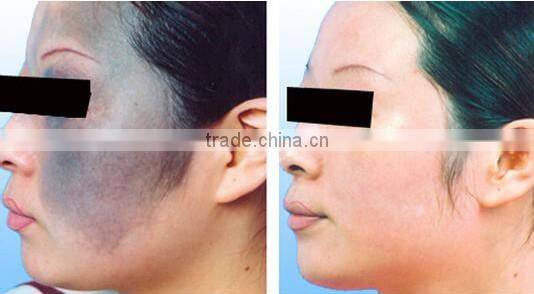 Q switch Nd Yag Laser price 1064nm &532nm wavelength