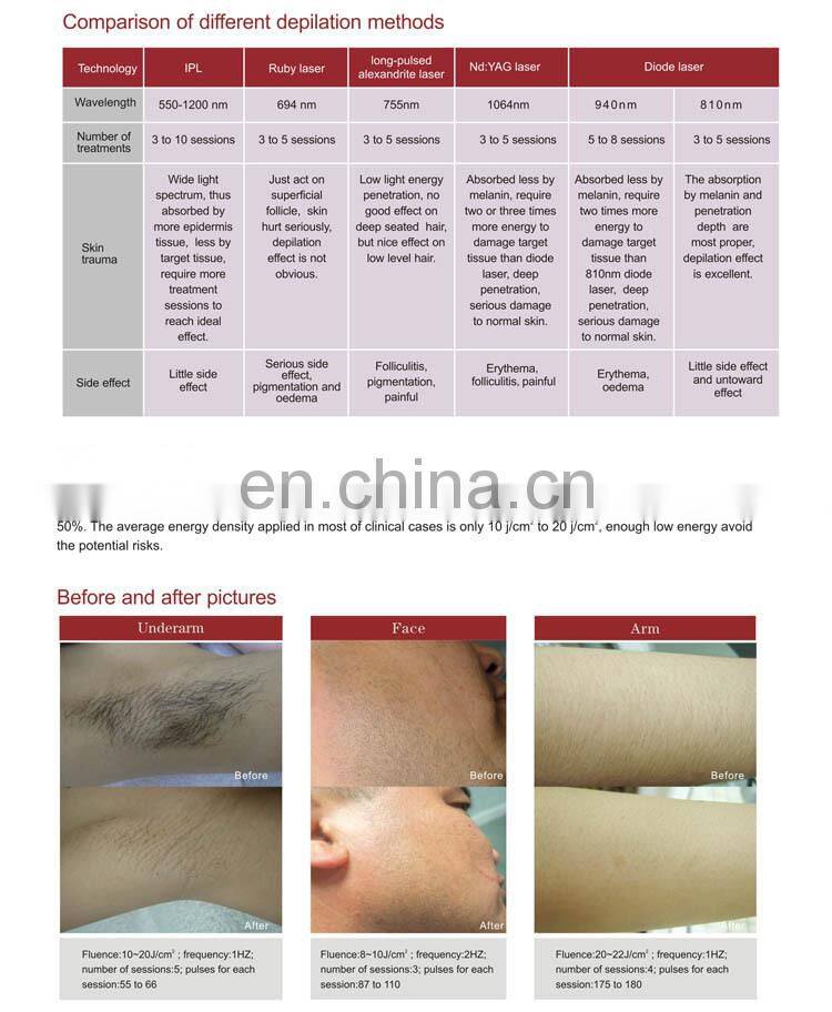 GSD 810nm diode laser permanent hair removal