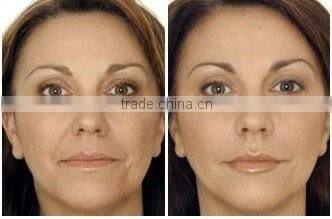 Merry christmas present !portable hifu rf wrinkle removal skin tightening machine for home use