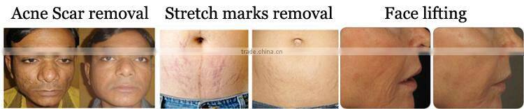 OEM ODM skin resurfacing co2 medical laser medical rf co2 fractional laser machine skin tightening