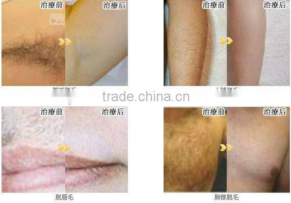Muti-Function Beauty Equipment IPL SHR Laser