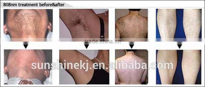 2017 portable CE approved Salon use 808nm laser elight beauty machine