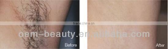 Most effective elight ipl rf laser hair removal and skin rejuvenation equipment