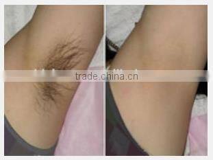 New arrival Germany Bars diode laser 808 hair remover feature for permanent hair removal